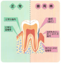 歯周病5.jpg
